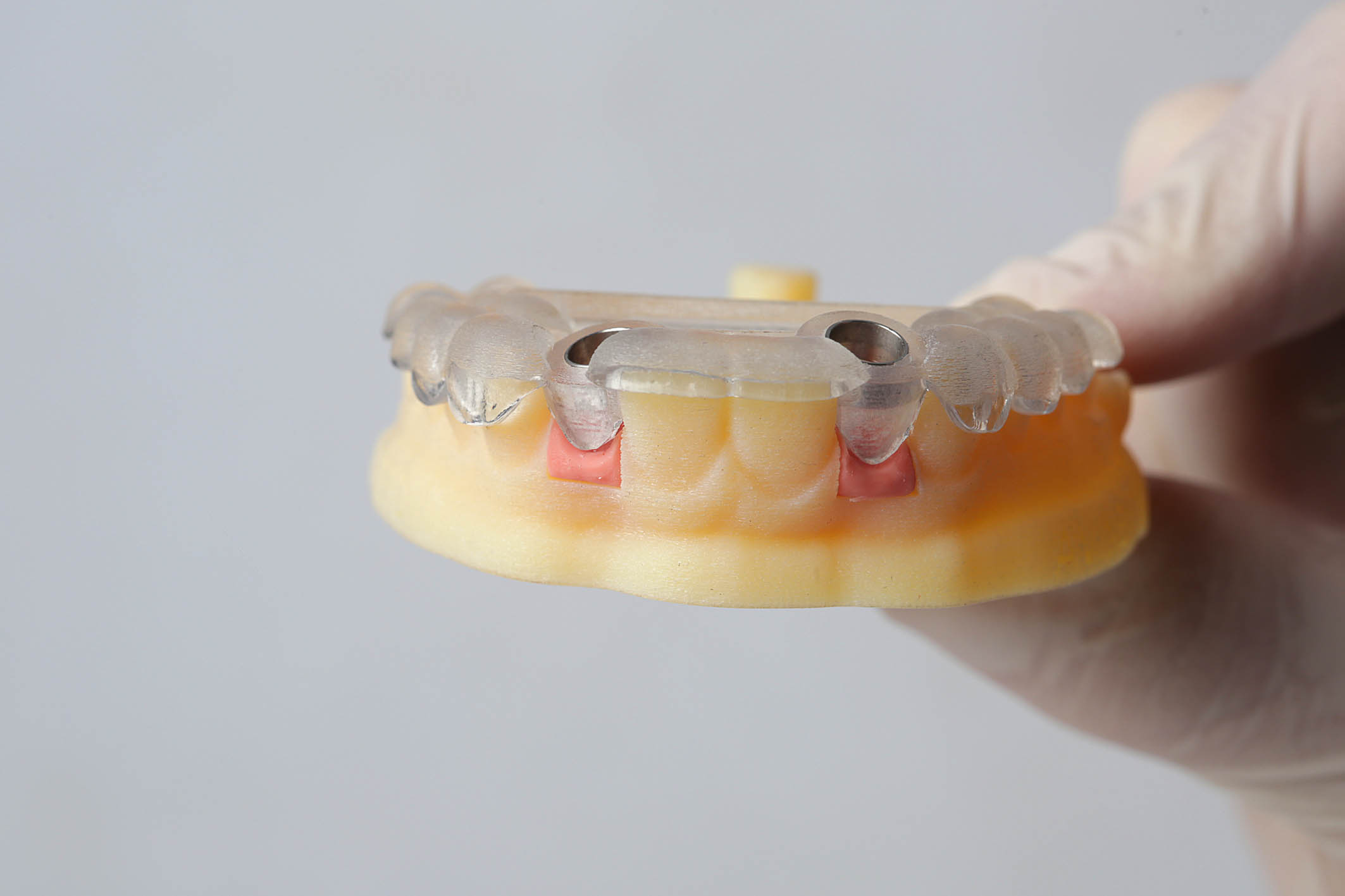 implant dentar, implantologie ghidata digital, stomatolog bun Cluj-Napoca, implant dentar Cluj, chirurgie dentara